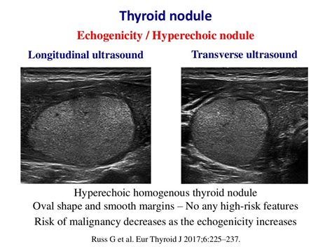 Ultrasound of thyroid nodules