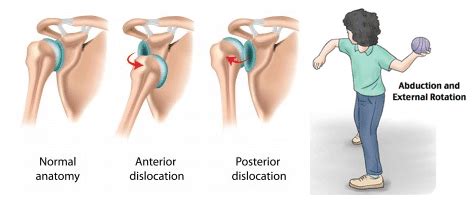 Shoulder Dislocations - Masnad Health Clinic