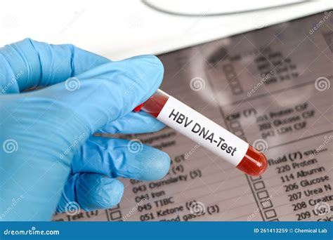 HBV DNA Test Test To Look for Abnormalities from Blood Stock Image ...