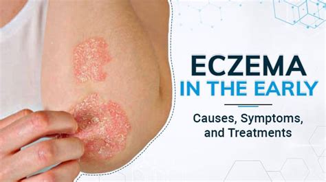 Eczema in the Early Years: Causes, Symptoms, and Treatments | Winston ...