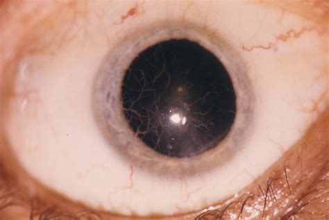 Corneal Dystrophy, Lattice Type I | Hereditary Ocular Diseases