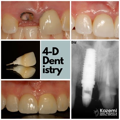 Implants for Front Teeth ( Smile Zone) | Implants for Front Teeth ...