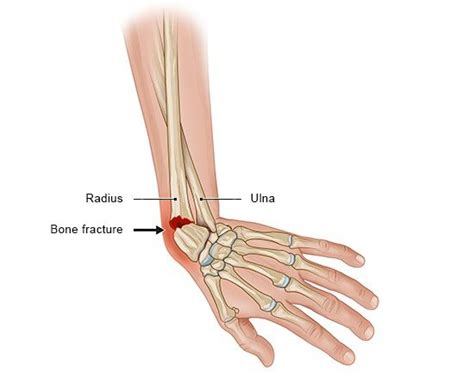 Wrist injuries | informedhealth.org