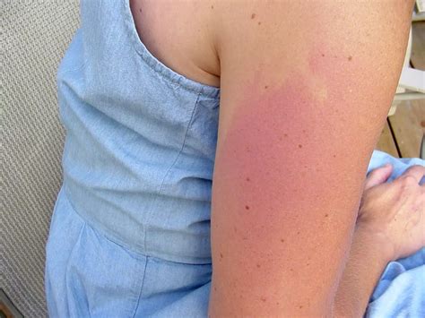 Moderna Rash On Body