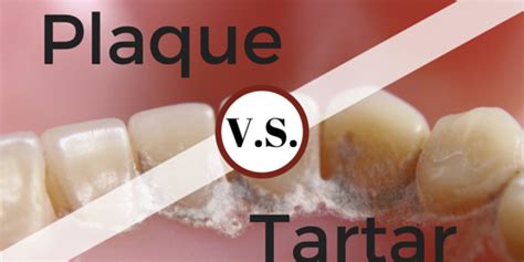 Plaque vs. Tartar: What's The Difference? - Britt Dental Center ...