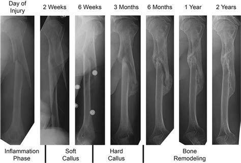 Humerus Fracture Healing