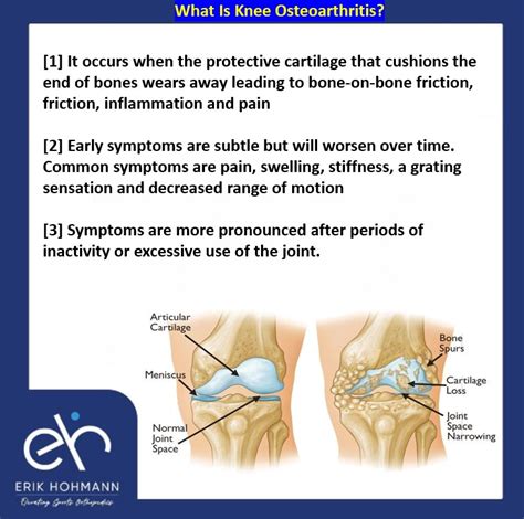 What is Knee Osteoarthritis? - Dr. Erik Hohmann