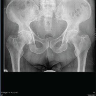 Plain film radiography compares pelvic radiographs from 2010 (a) and ...