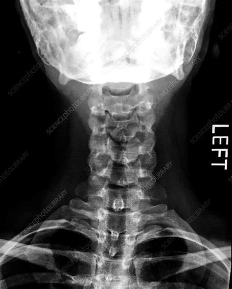 Normal Cervical Spine, X-Ray - Stock Image - C039/3917 - Science Photo ...