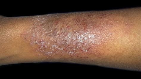 Dry Skin Patches Causes Symptoms Diagnosis And Treatments