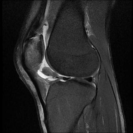 Non-displaced patellar fracture - MRI | Radiology Case | Radiopaedia.org