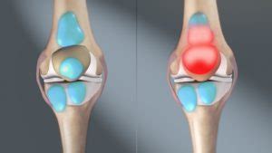 Prepatellar Bursitis | Knee Pain Info