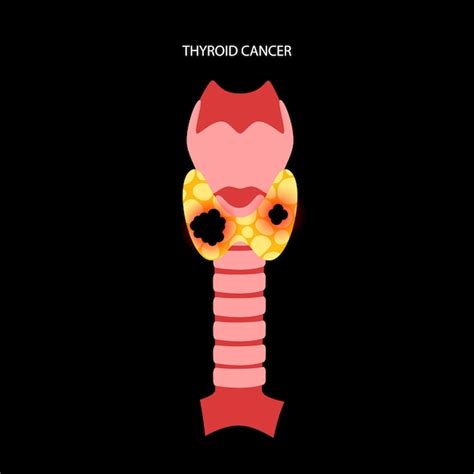 Premium Vector | Thyroid cancer stages