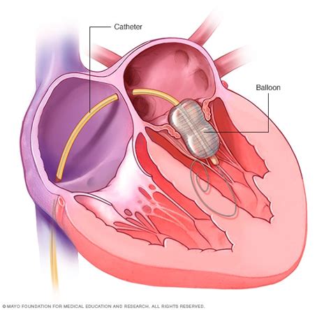 Balloon valvuloplasty - Mayo Clinic