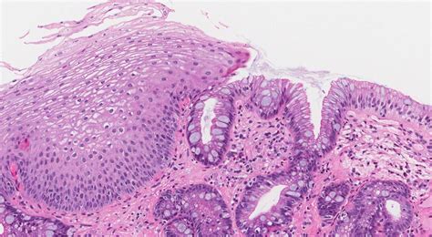 Barretts esophagus | MyPathologyReport.ca