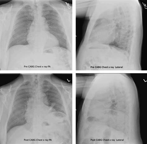 Phrenic nerve injury and diaphragm dysfunction in a patient after ...