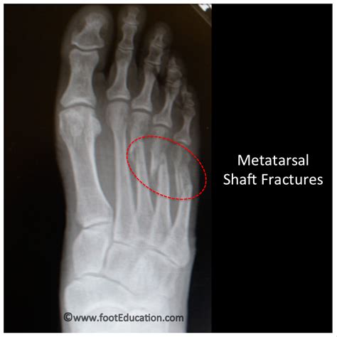 Metatarsal Shaft Fractures - FootEducation