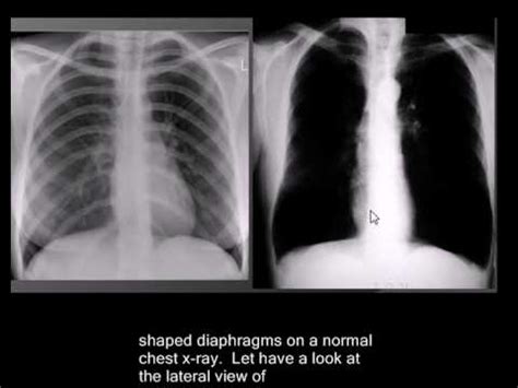 Normal chest x ray findings - questaf