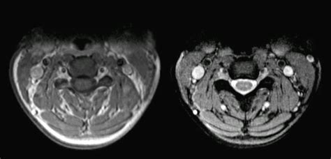 Normal Cervical Spine Axial Mri | Hot Sex Picture