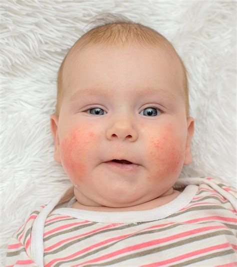 Swollen Cheeks Causes, Red, In Toddler and Inside Mouth - American Celiac