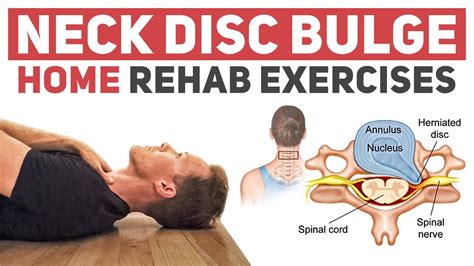 What Exercises To Avoid With Bulging Discs In Neck - Infoupdate.org