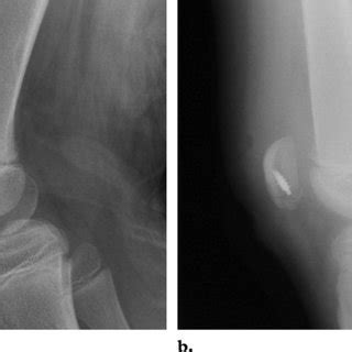 Patellar sleeve fracture in an 11-year-old boy who was injured when he ...