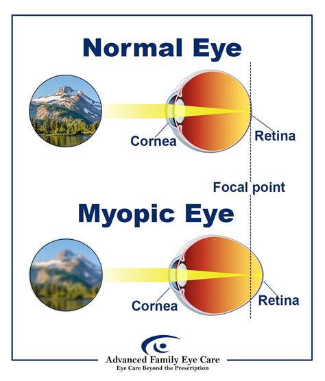 Myopia (Nearsightedness) Q&A | Advanced Family Eye Care