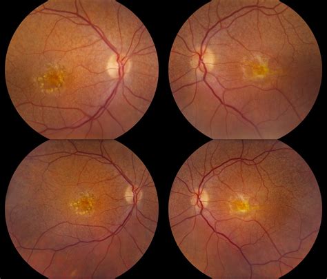 Whitman Images: Macular Dystrophy with Surrounding Drusen