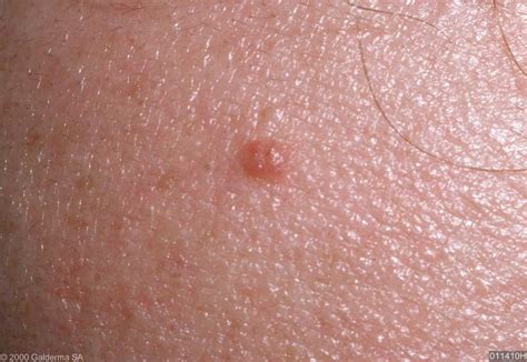 intradermal nevus - pictures, photos