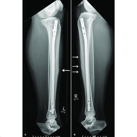 | Lateral x-ray of left (A) and right (B) tibia and fibula. | Download ...