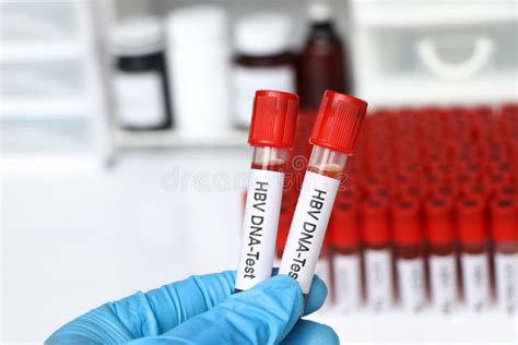 HBV DNA Test Test To Look for Abnormalities from Blood Stock Image ...