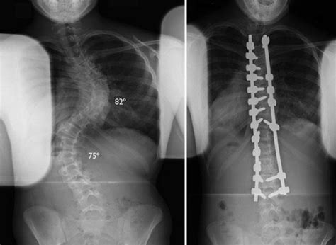 Surgical Treatment for Scoliosis - OrthoInfo - AAOS