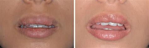 Lip Reduction Photos | Miami, FL | Patient 1478