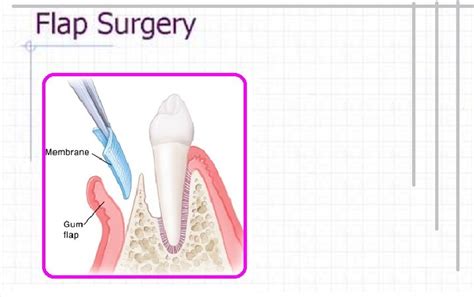 flap surgery - pictures, photos