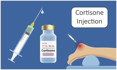 Cost of Cortisone Injections Privately in UK - Sport Doctor London