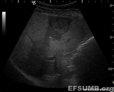 Hemangioma 004 [6 images & 4 video] – EFSUMB