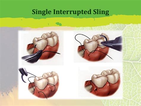 Periodontal Flap Surgery