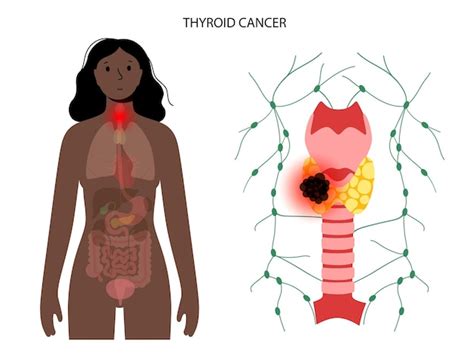 Premium Vector | Thyroid cancer stages