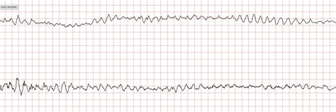 Ventricular Flutter Vs Torsades