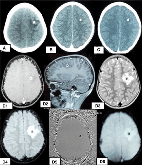 (A-D) Neuroimaging of a child with calcified granuloma. (A-C) Axial ...