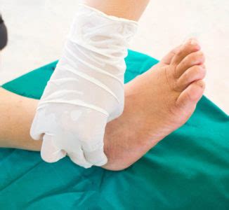 Understanding Charcot Arthropathy | Edina Orthopedic Surgeon