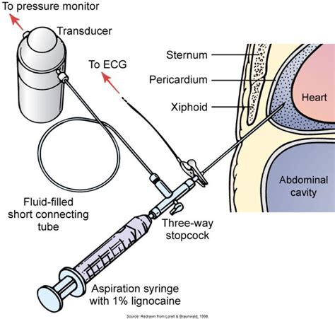 Pericardiocentesis performed under sterile conditions in conjunction ...