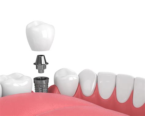 Your Dental Implant Recovery Timeline - Aubrey Baudean DDS