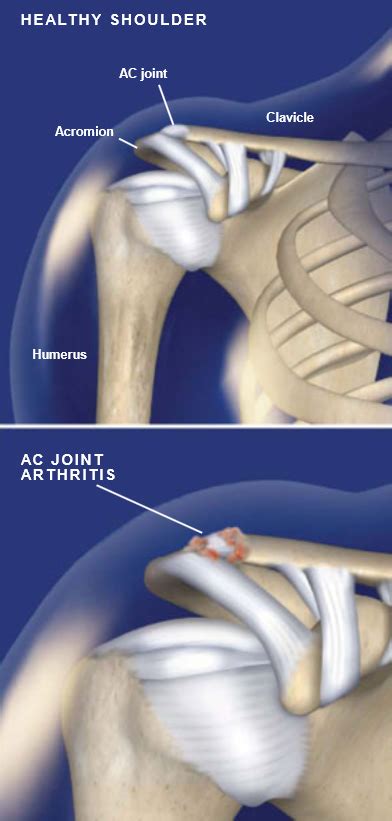 Acromioclavicular (AC) Joint Arthritis | Central Coast Orthopedic ...