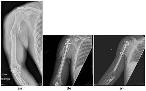 Proximal Humerus Fracture Presentation