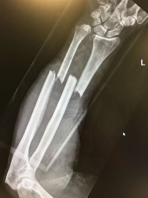 Distal Radial Ulnar Joint (DRUJ) Injuries - Trauma - Orthobullets