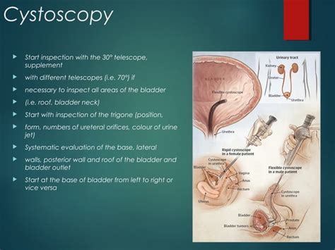 CYSTOSCOPY