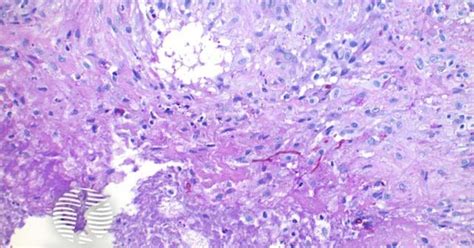 DermNet® - Phaeohyphomycosis pathology image