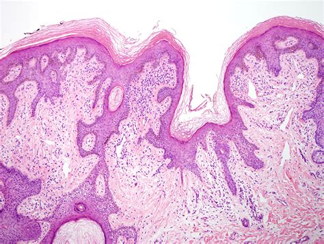 Epidermal Nevus | Dermatopathology