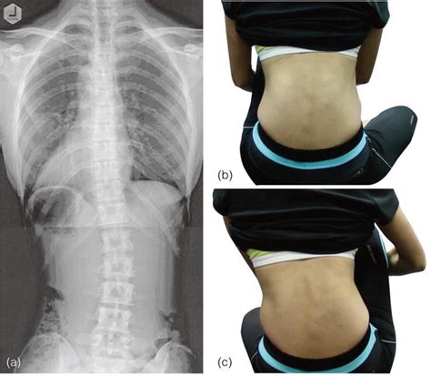 Conservative Treatment of Degenerative Lumbar Scoliosis | IntechOpen